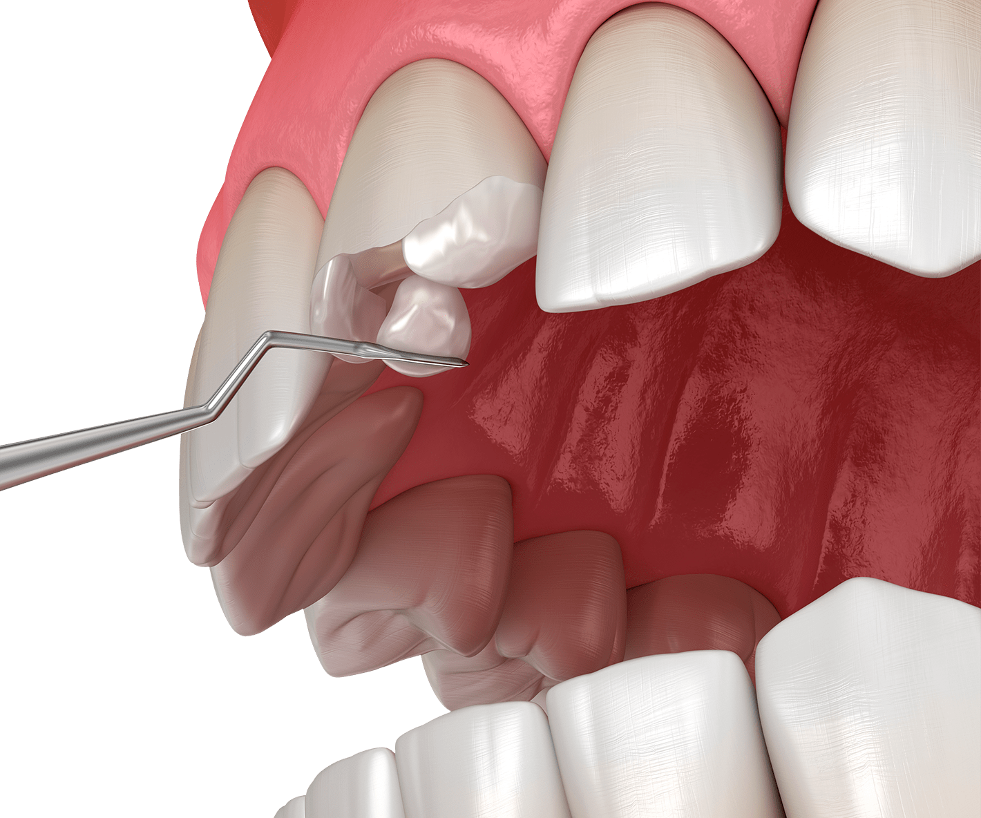 Композитна реставрація