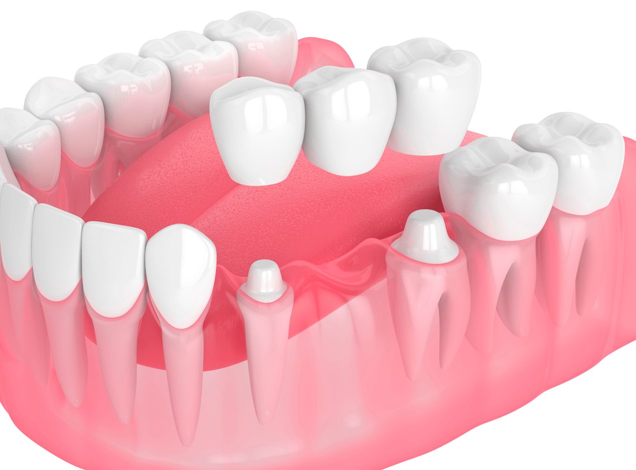 Примірення зубного моста
