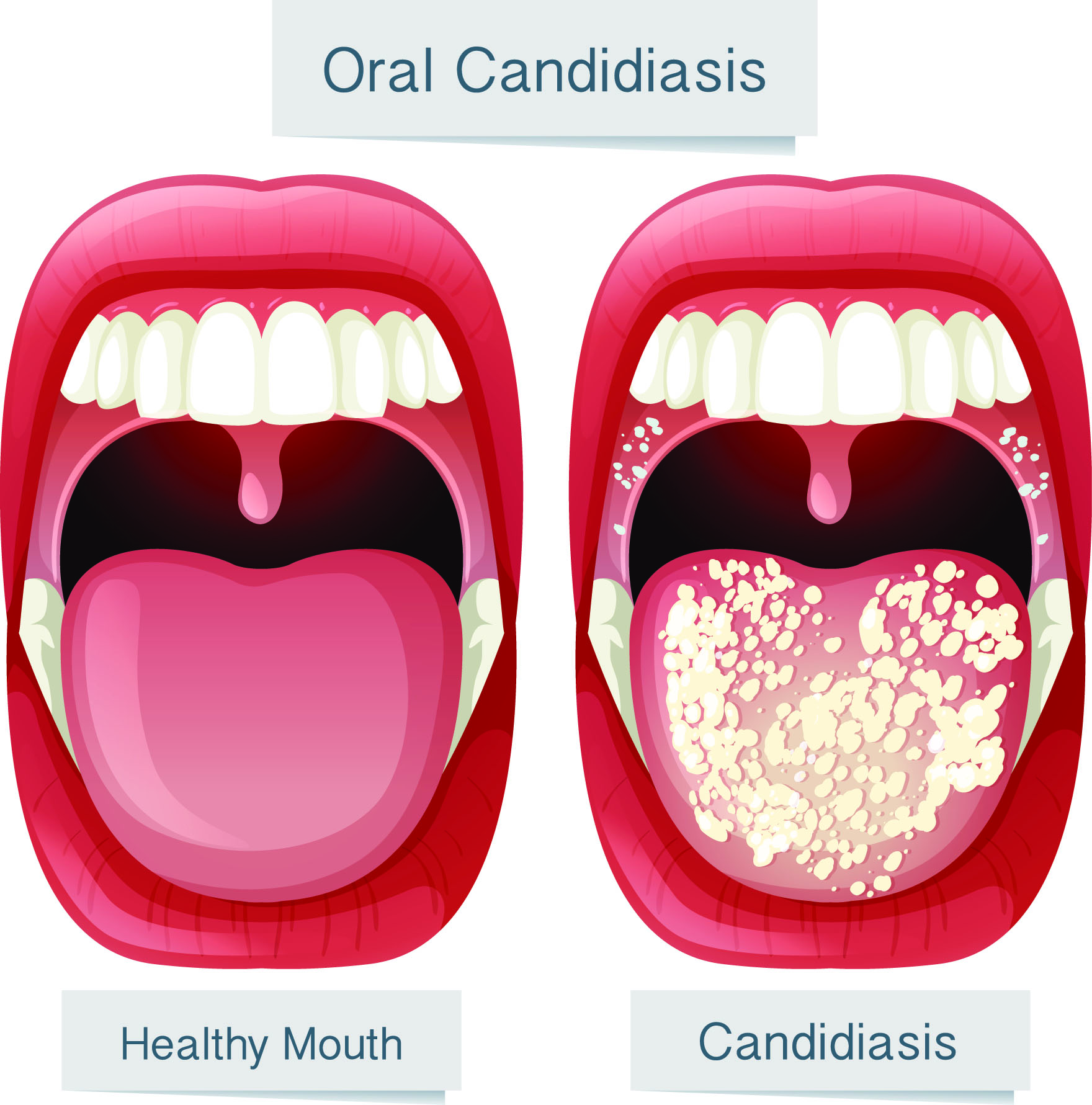 Кандидоз у роті