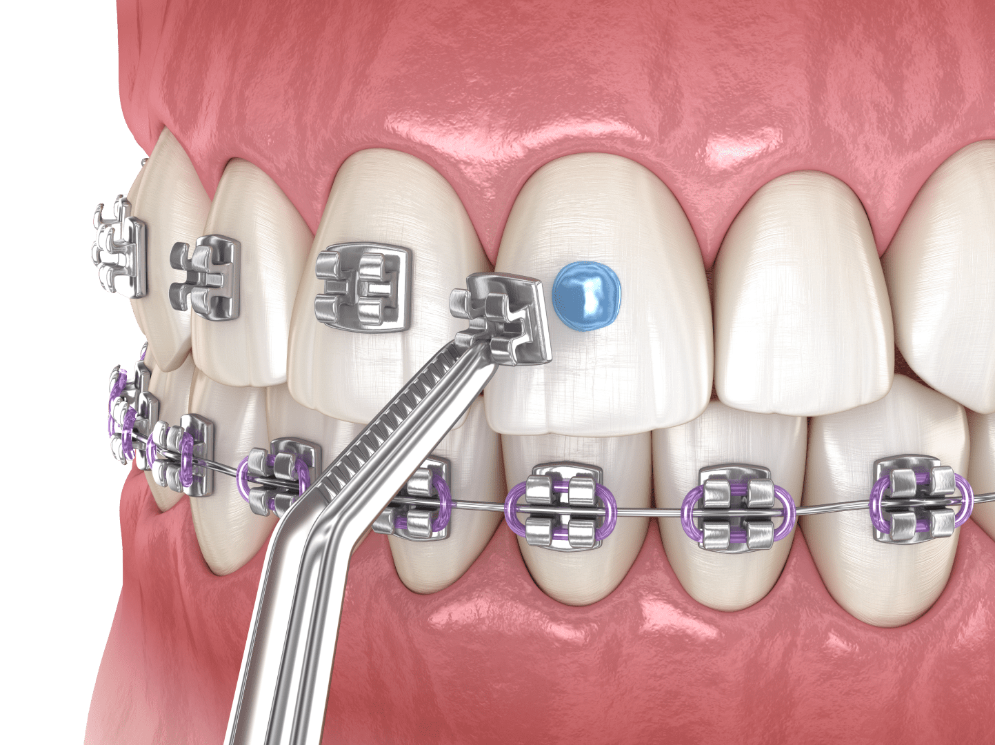 Встановлення брекетів