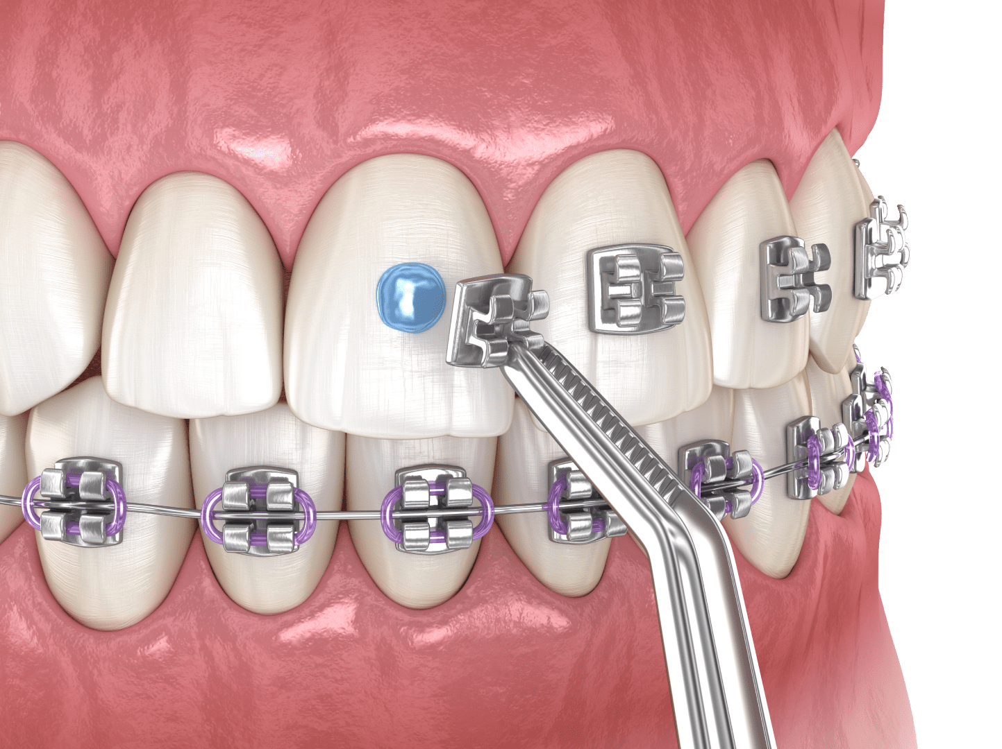 Встановлення брекетів