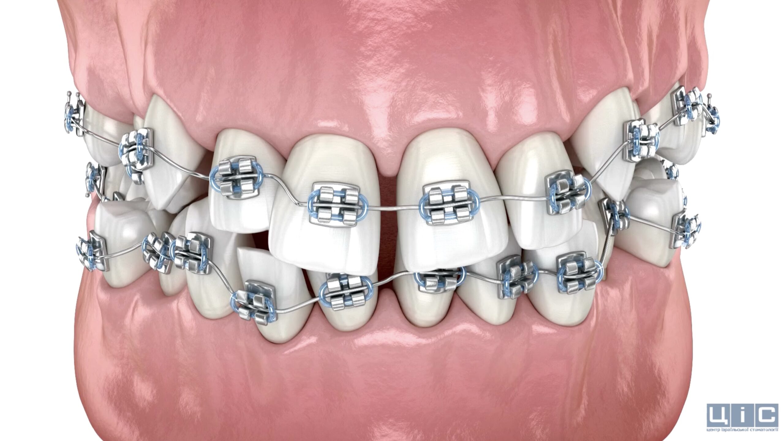 Вирівнювання зубів