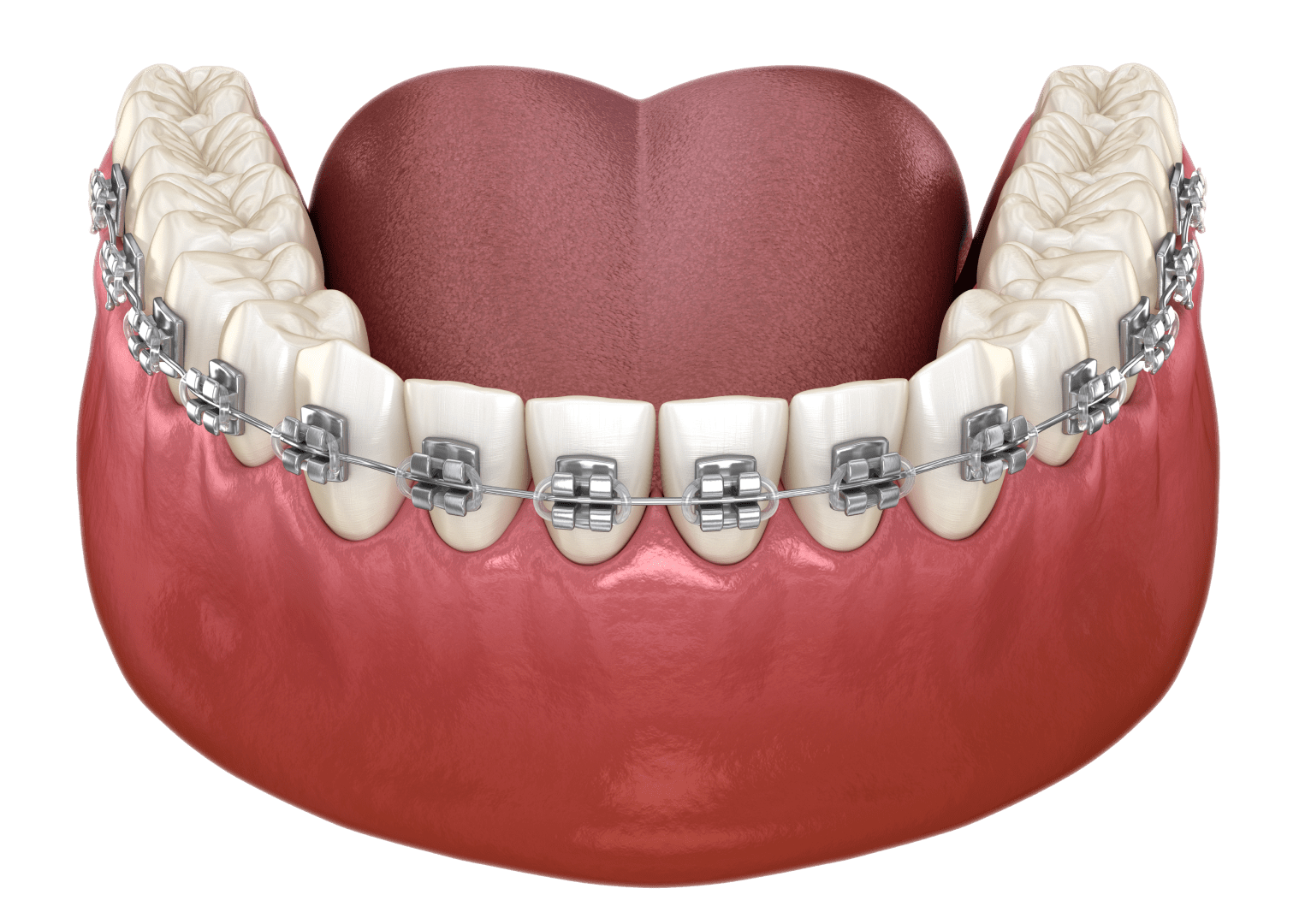 Вестибулярні брекети