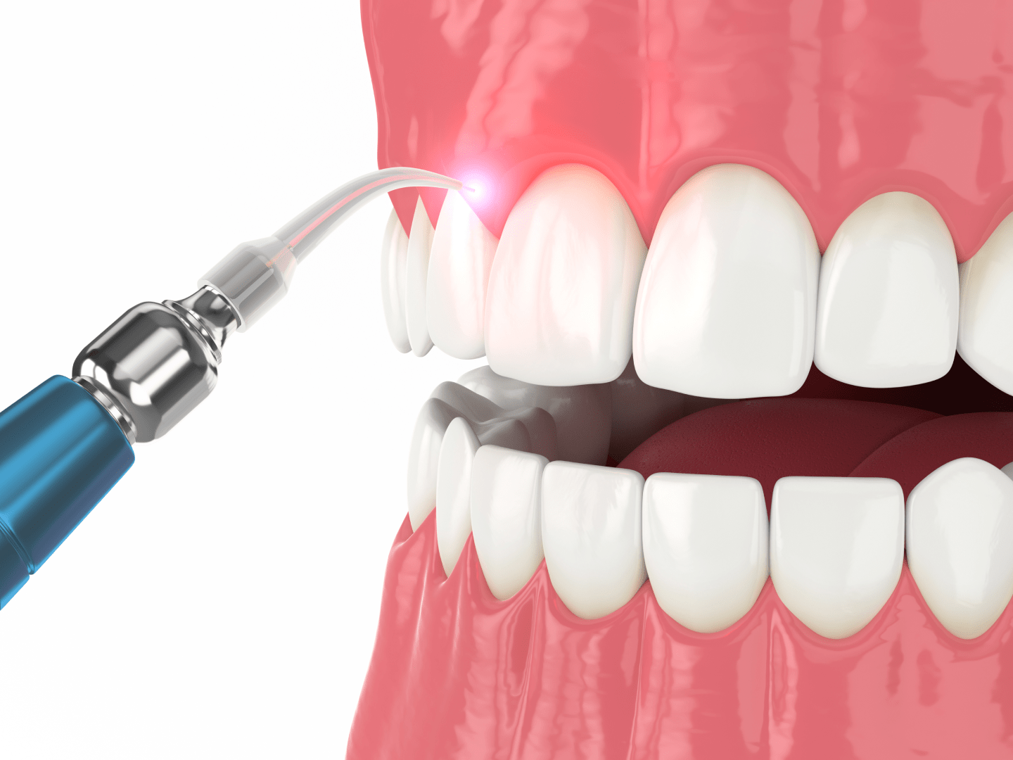 Ультразвукове відбілювання