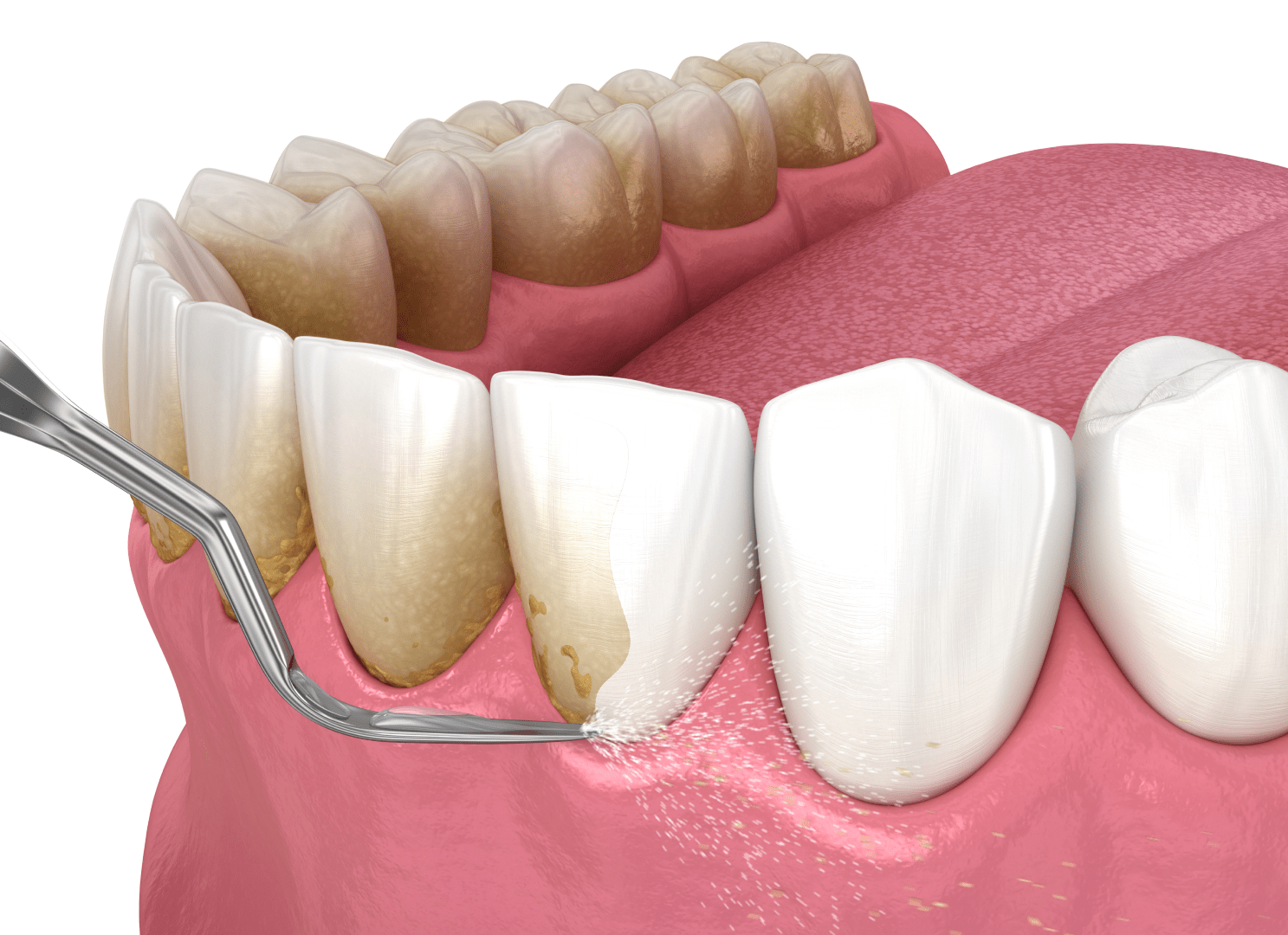 Ультразвуковая чистка зубов