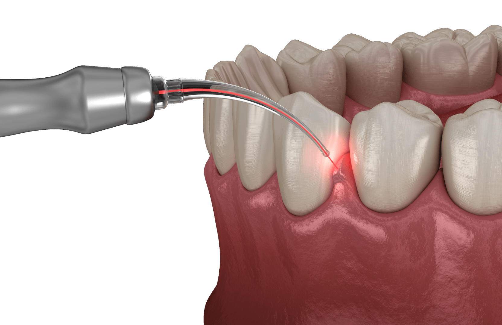 Лазерна чистка зубів