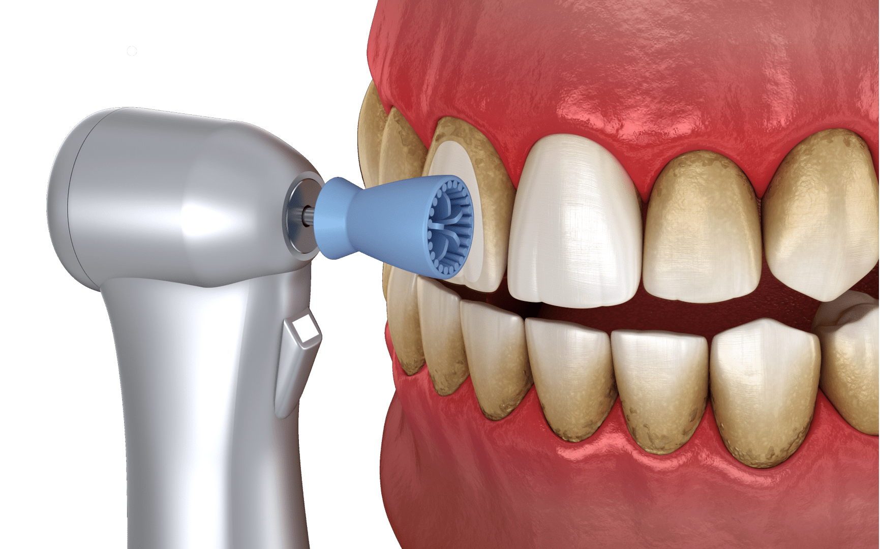 Удаление отложений