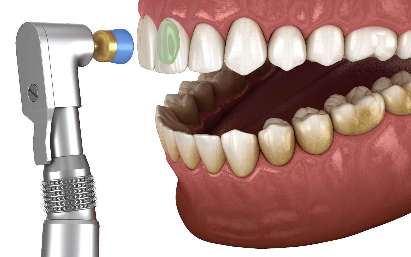 Полировка зубов