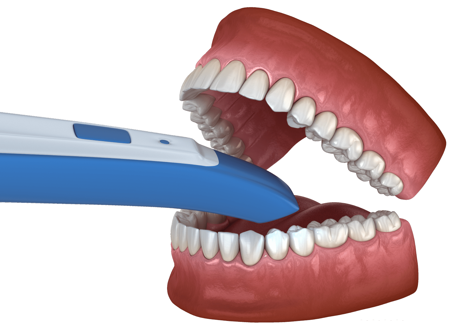 Відбілювання зубів