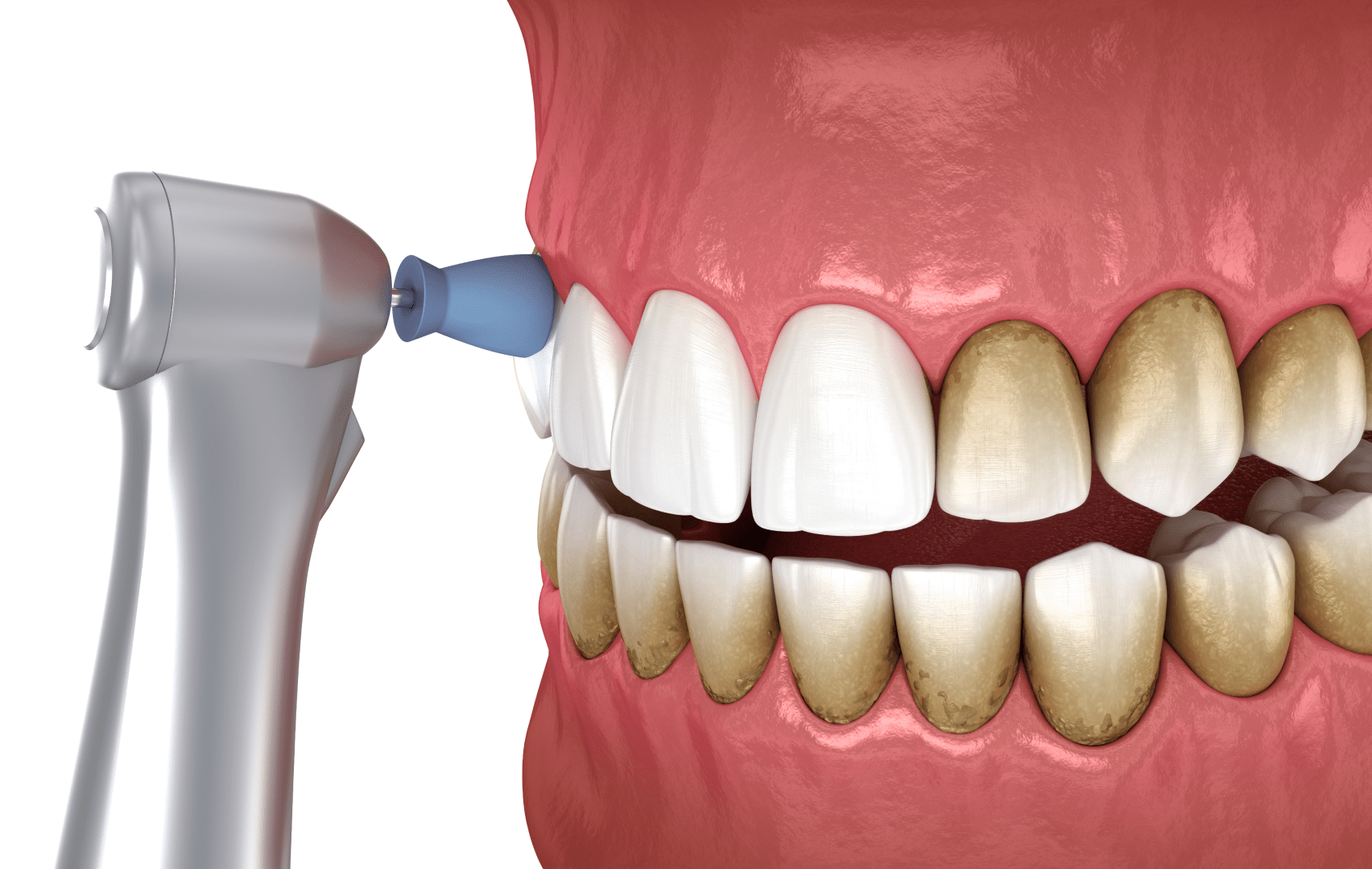 Механічне відбілювання