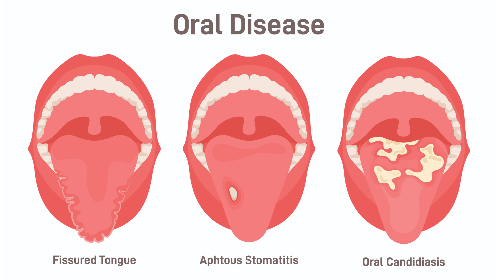 Наліт на язику - причини та лікування