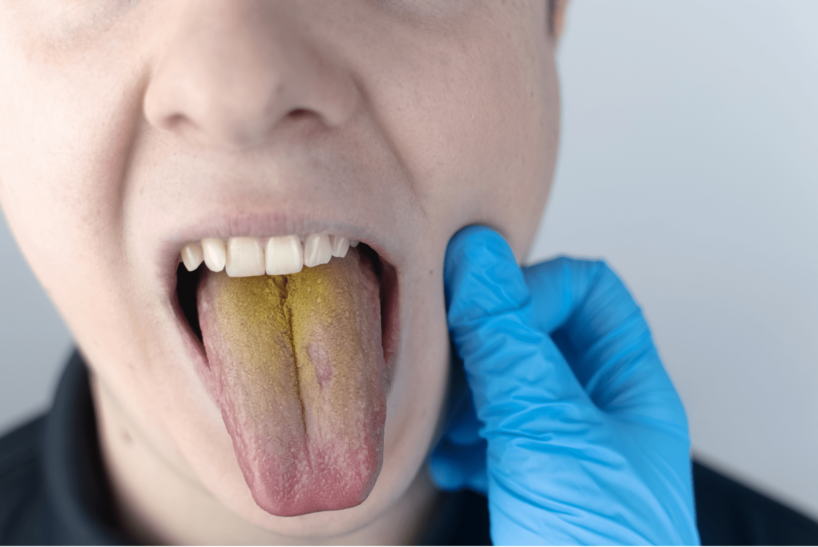 Жовтий наліт на язику