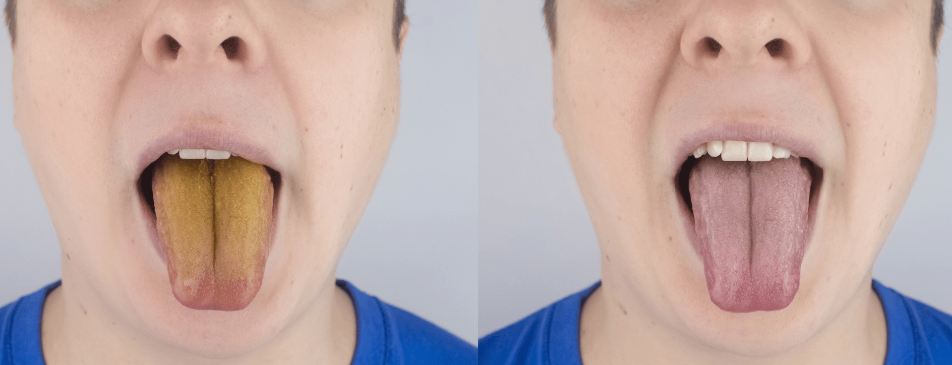 Жовтий наліт на язику