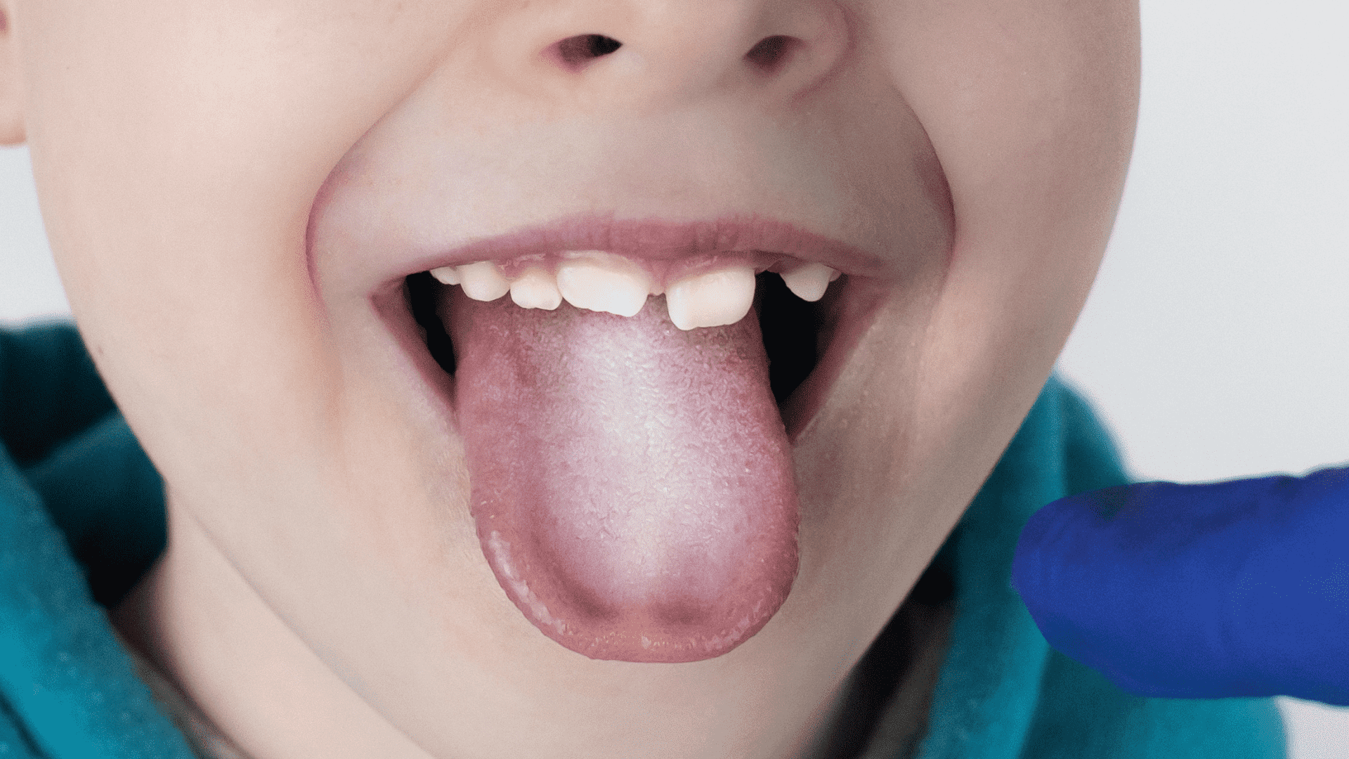 Наліт на язику - причини та лікування