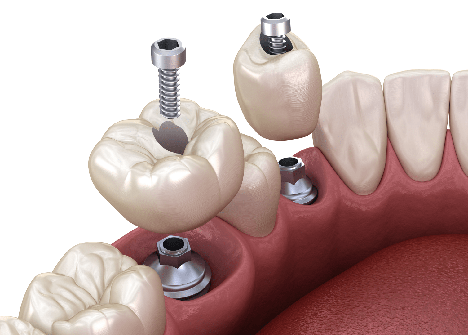 Цирконієві коронки