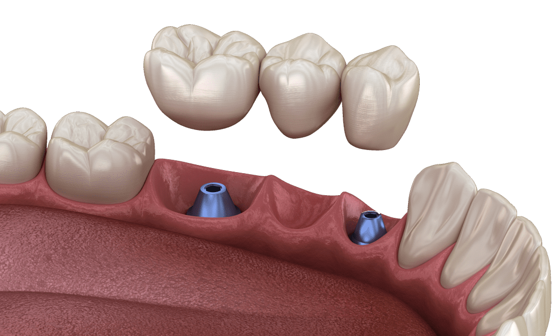 Пластмасові коронки