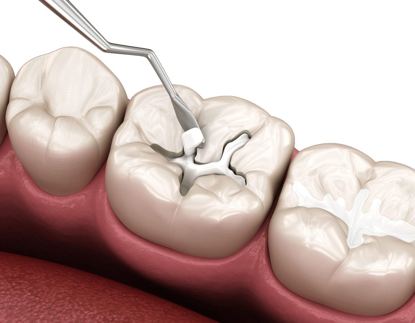 Видалення каріозної порожнини