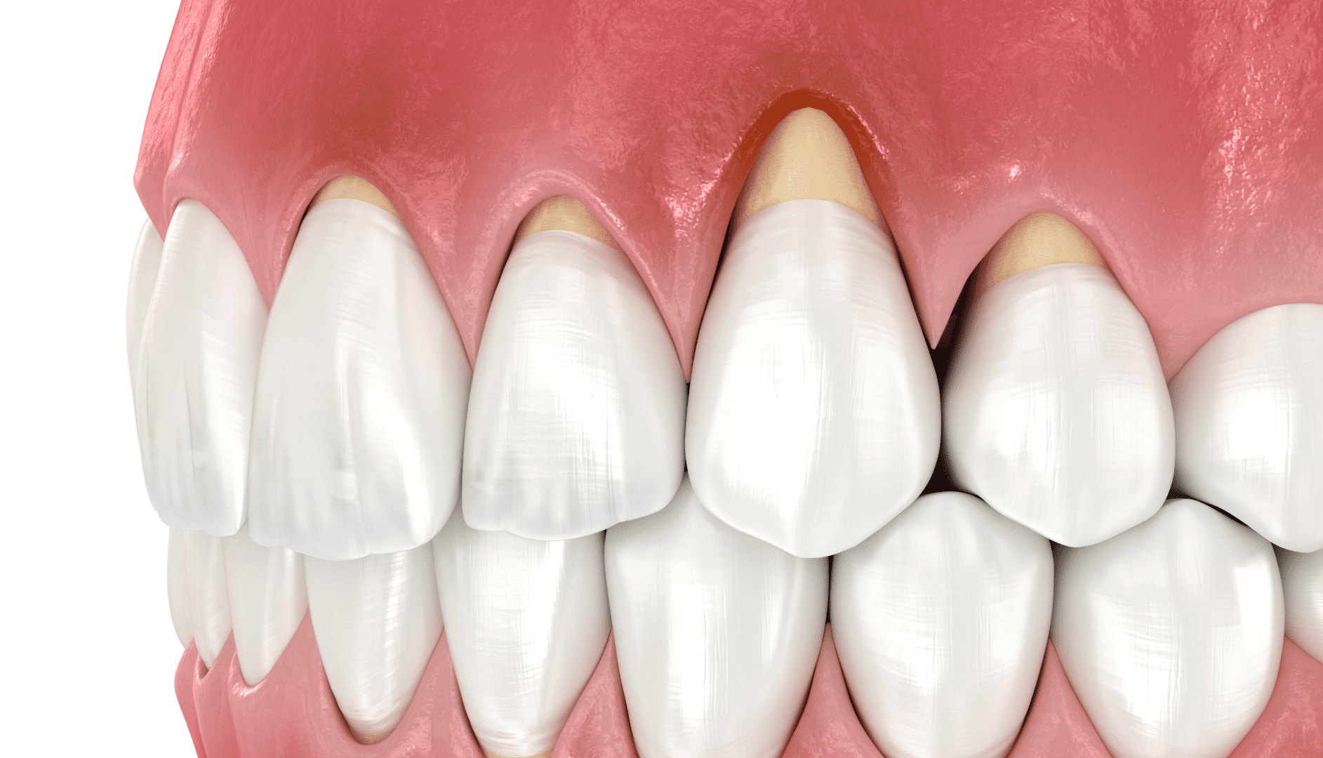 Клиноподібний дефект