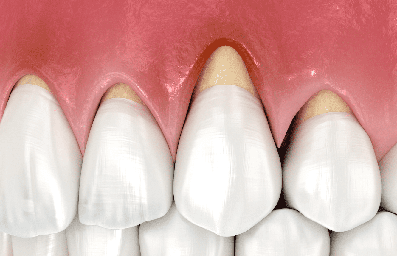 Клиноподібний дефект