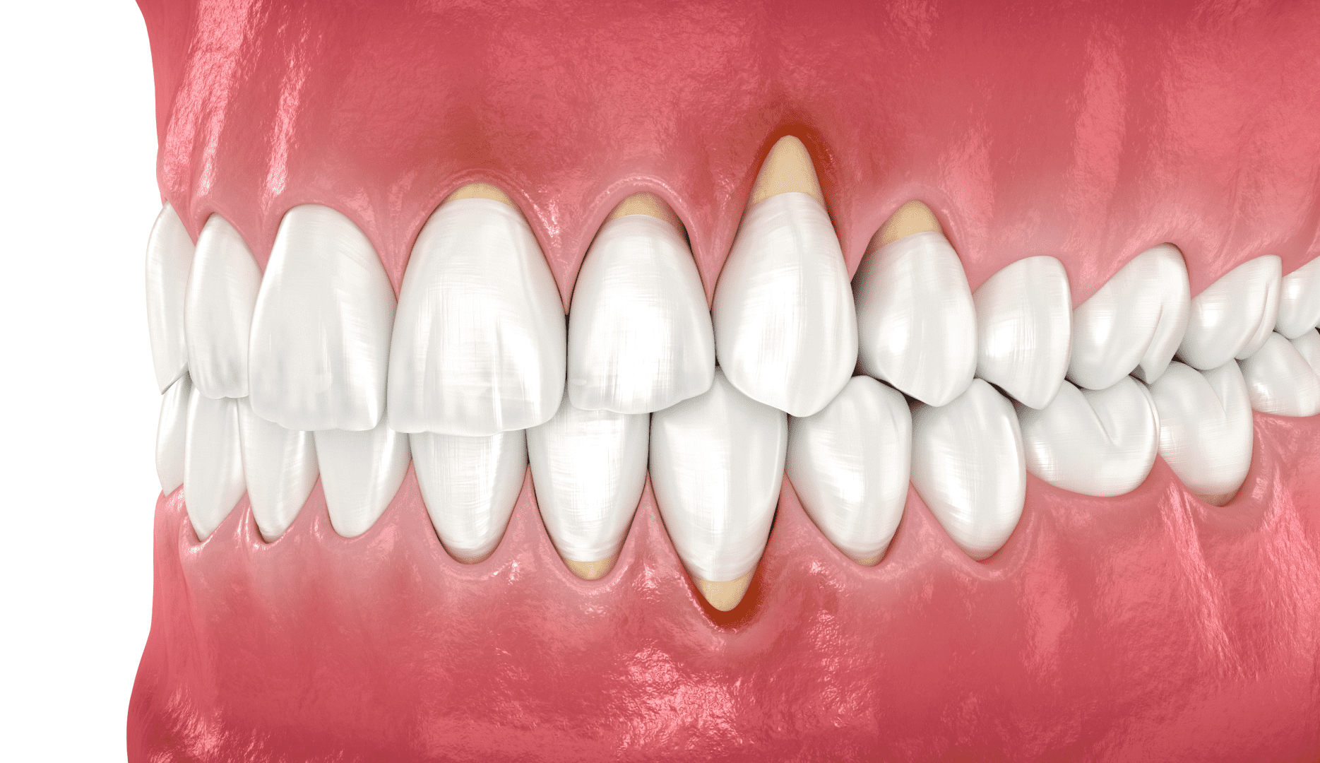 Клиноподібний дефект