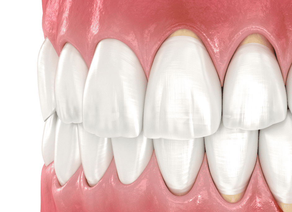 Клиноподібний дефект