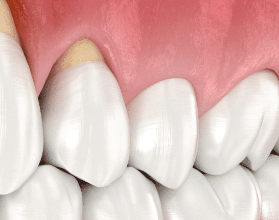 Клиноподібний дефект