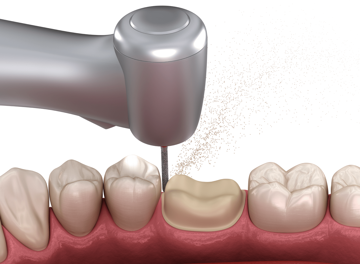 Підготовка зубів