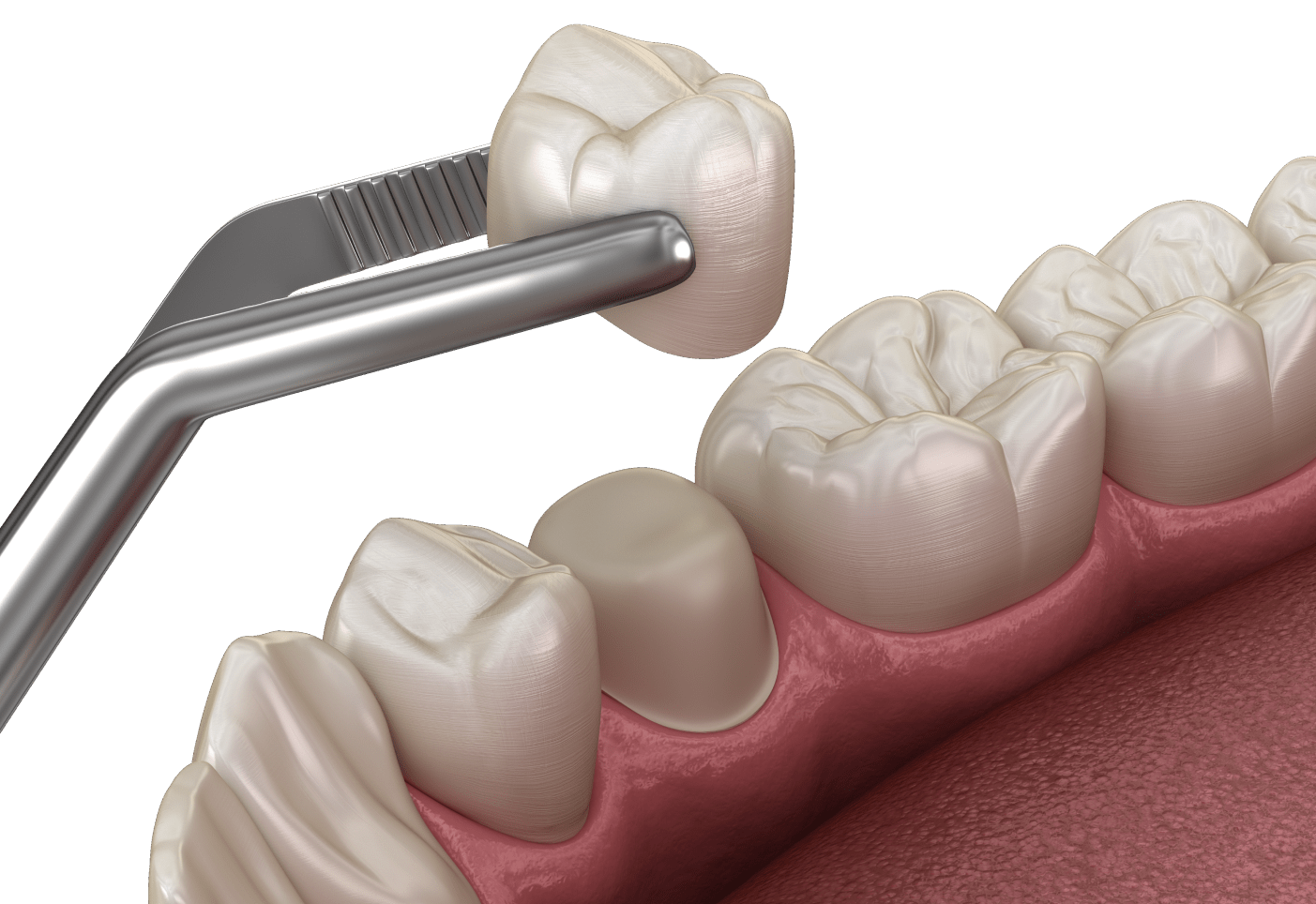 Безметалова кераміка
