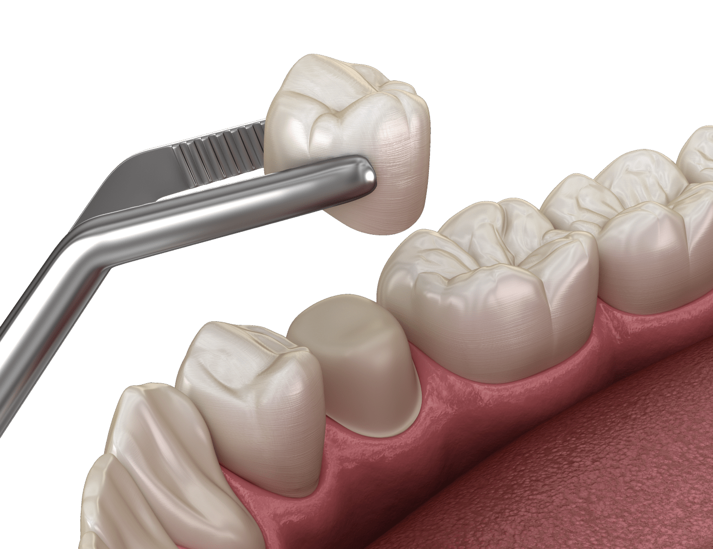 Керамічні коронки