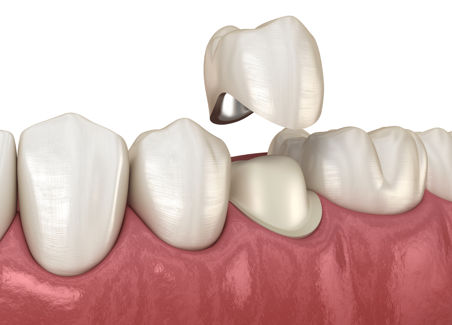 Металокерамічні коронки