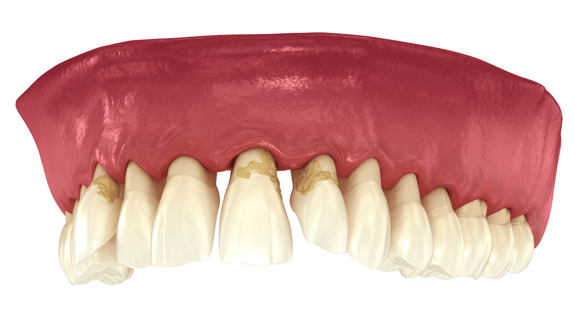 Пародонтоз
