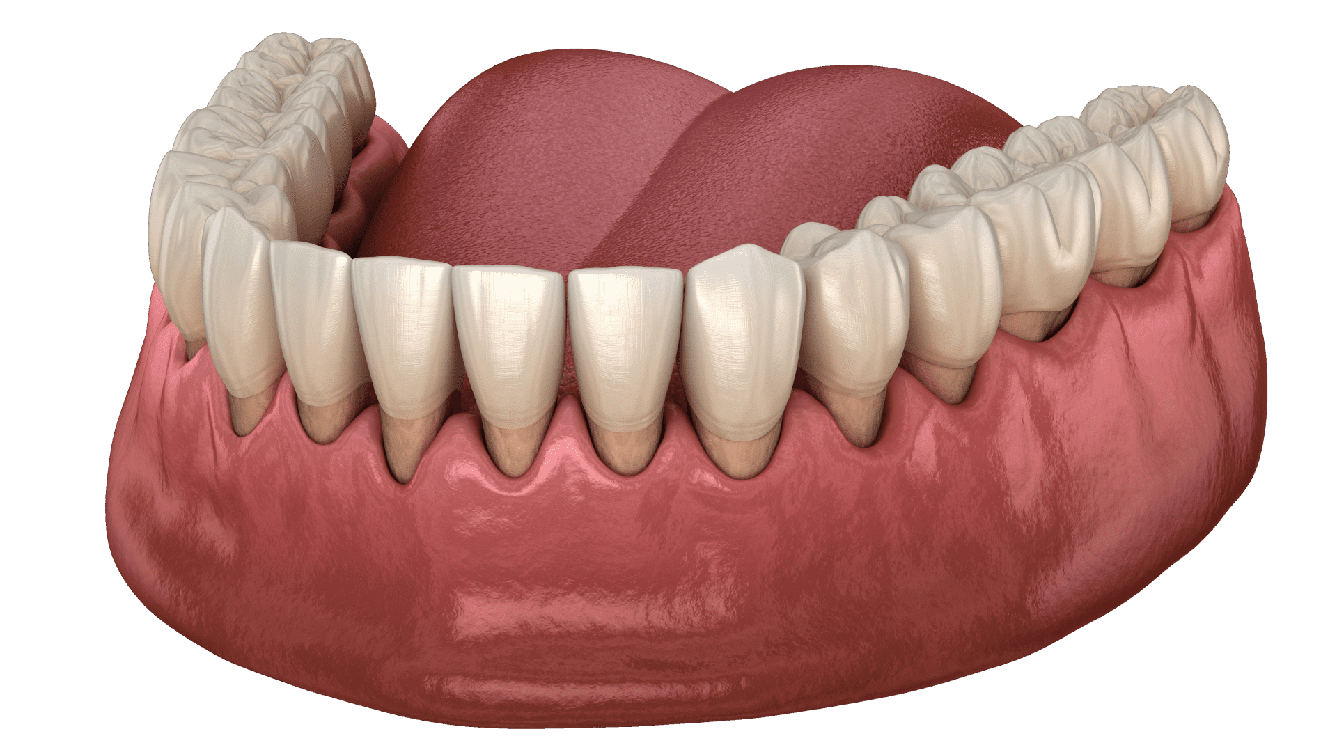 Пародонтит