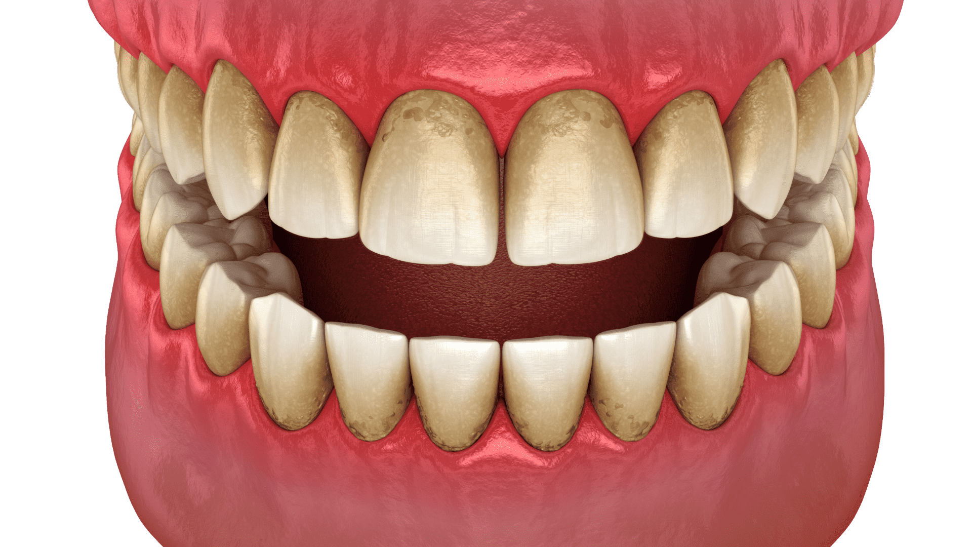 Лікування ясен