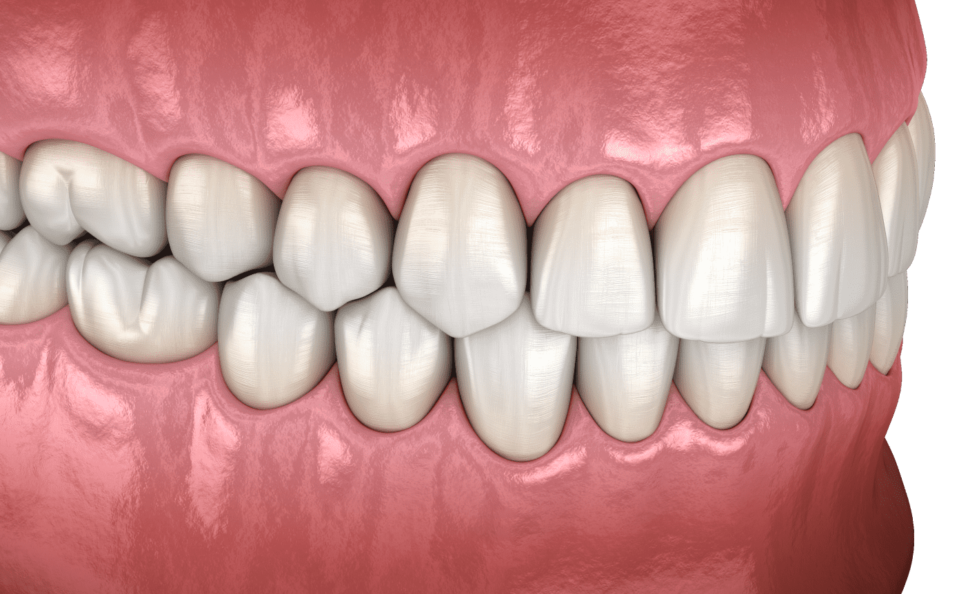 Ортогнатичний прикус