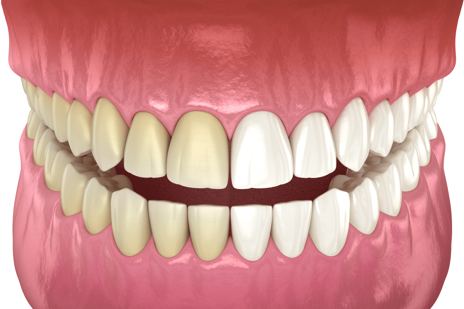 Відбілювання зубів