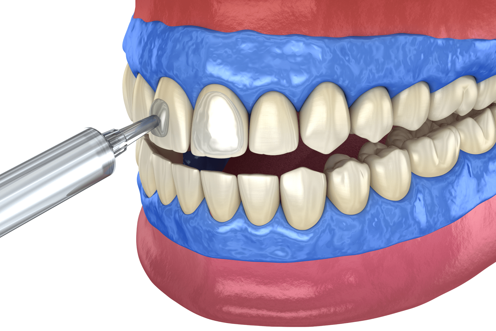 Відбілювання зубів