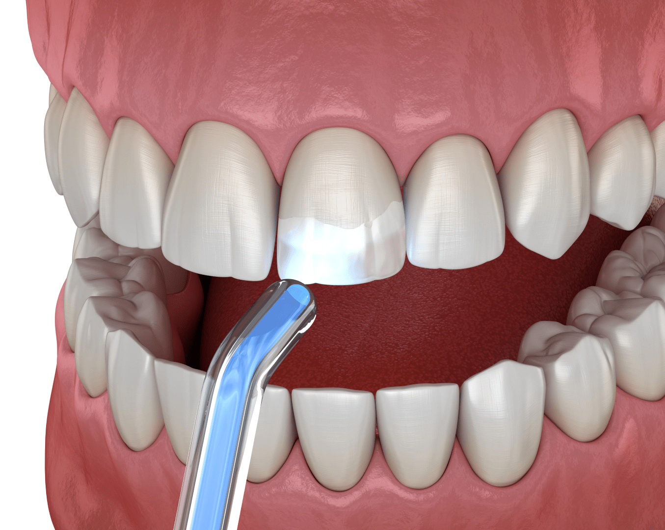 Лазерне відбілювання