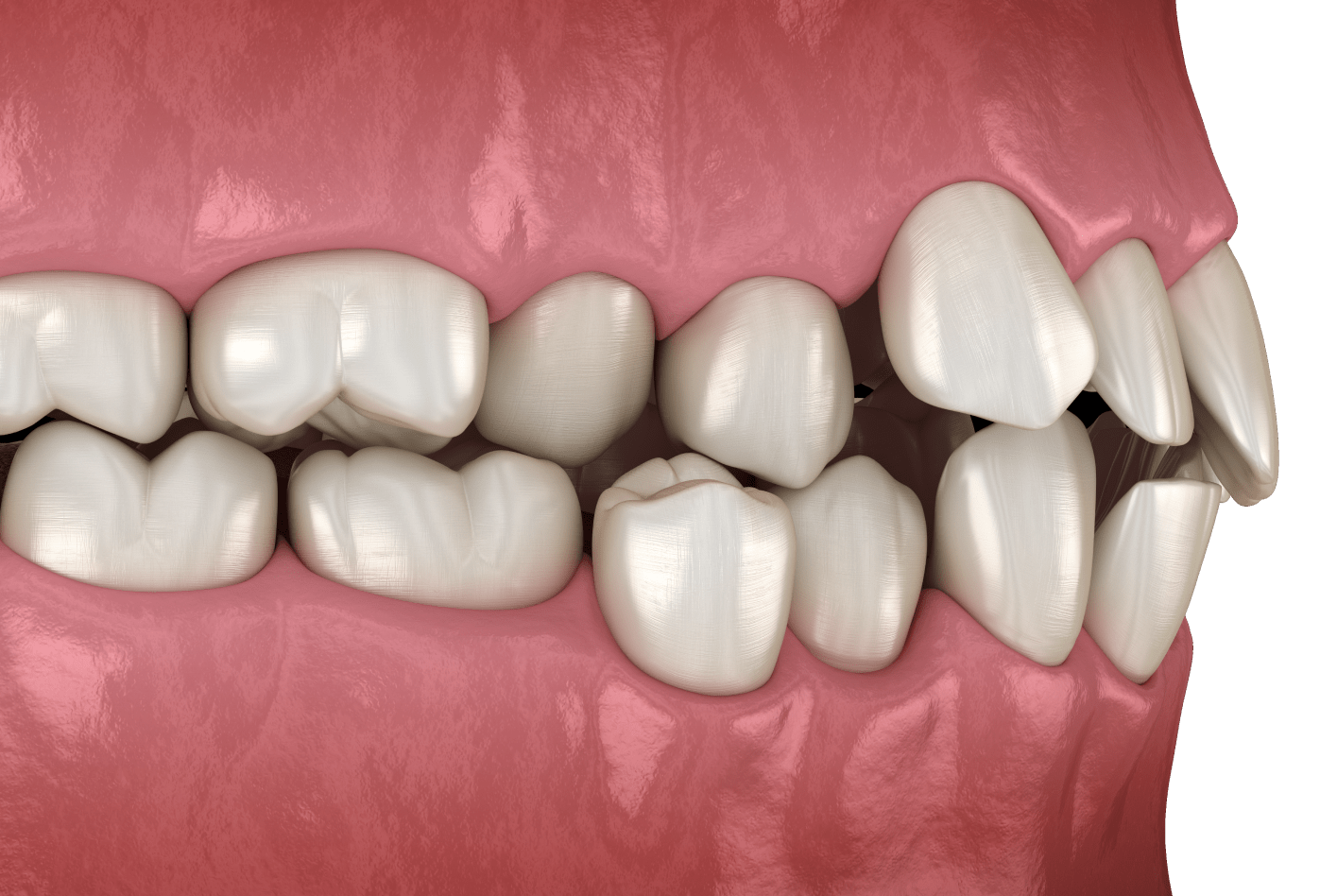 Перехресна оклюзія