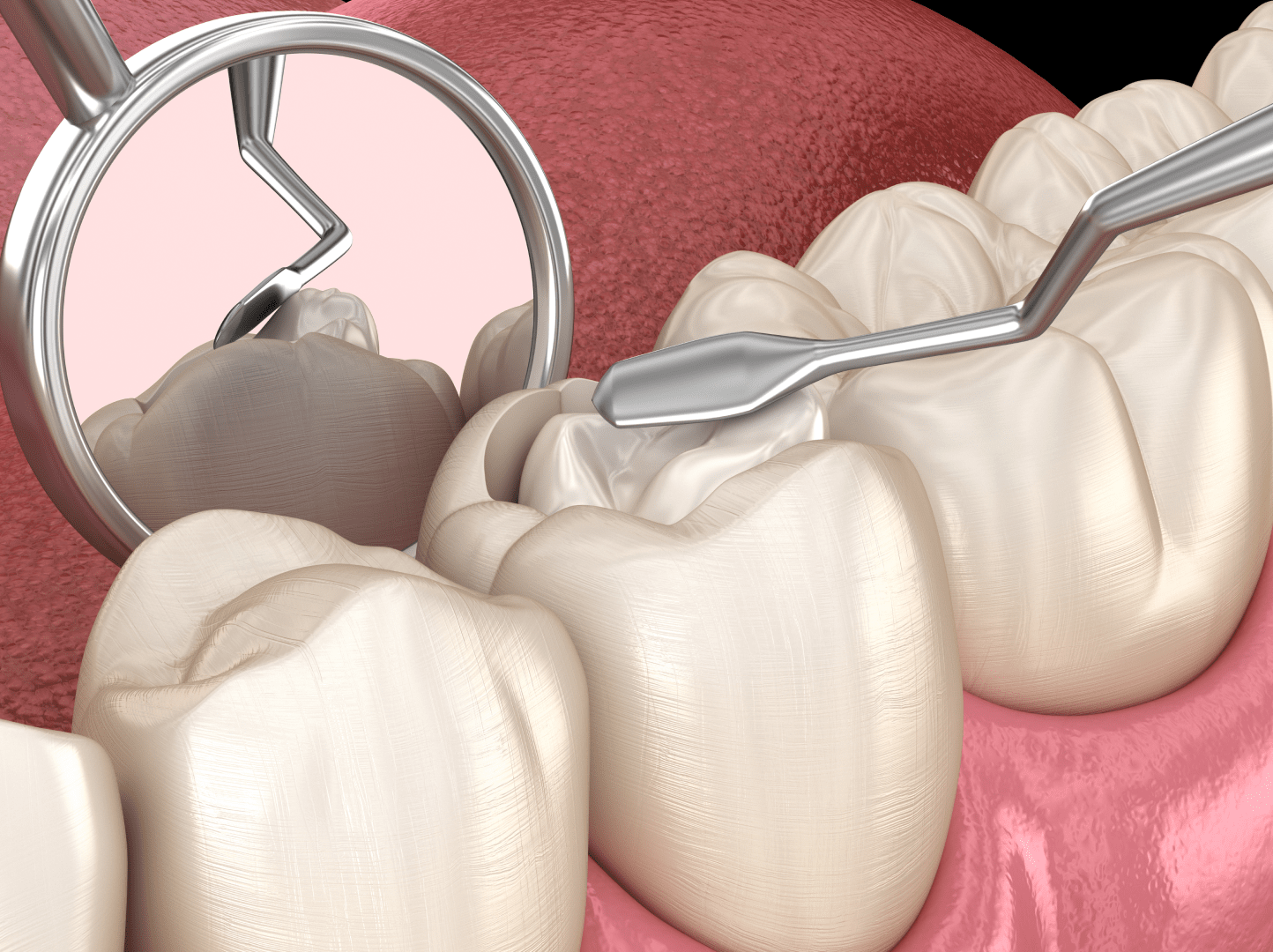 Підготовка та препарування