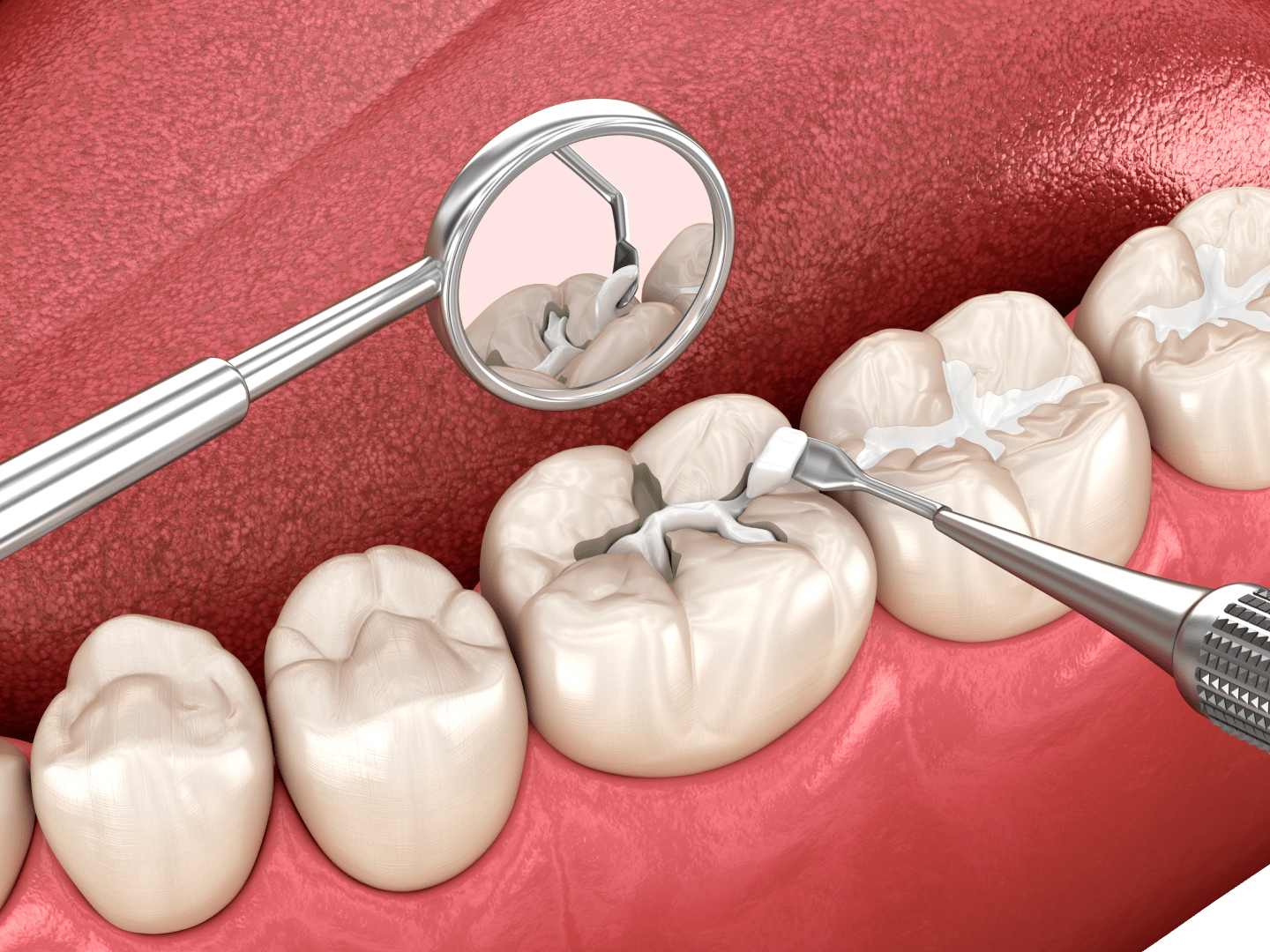 Пломбування зубів