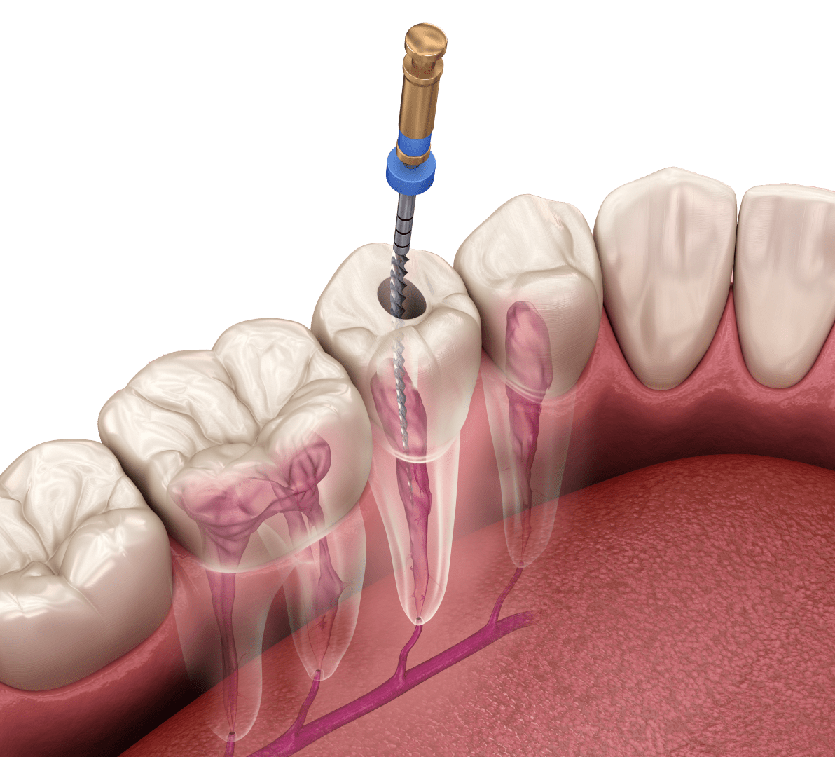 Пломбування кореневих каналів