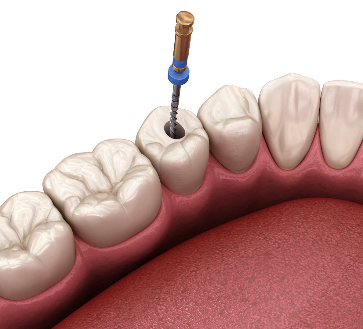 Видалення пульпи