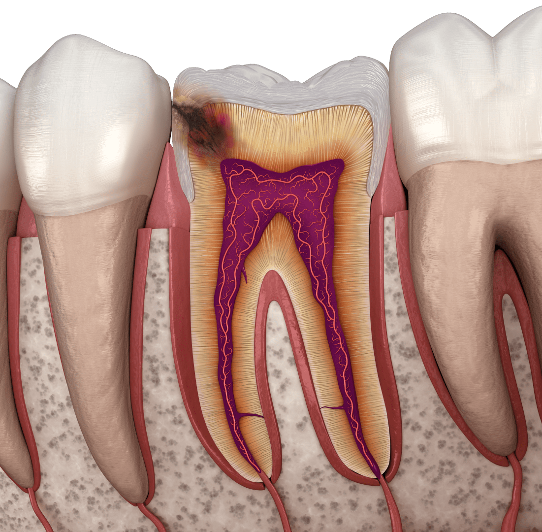 Хронічна стадія пульпіту