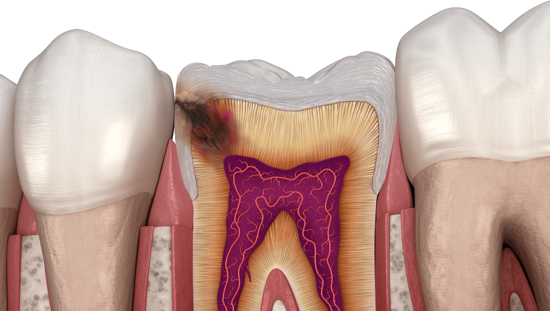 Лікування пульпіту