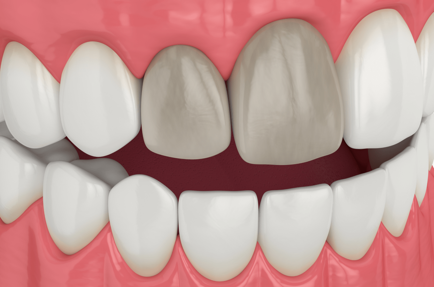 Лікування пульпіту