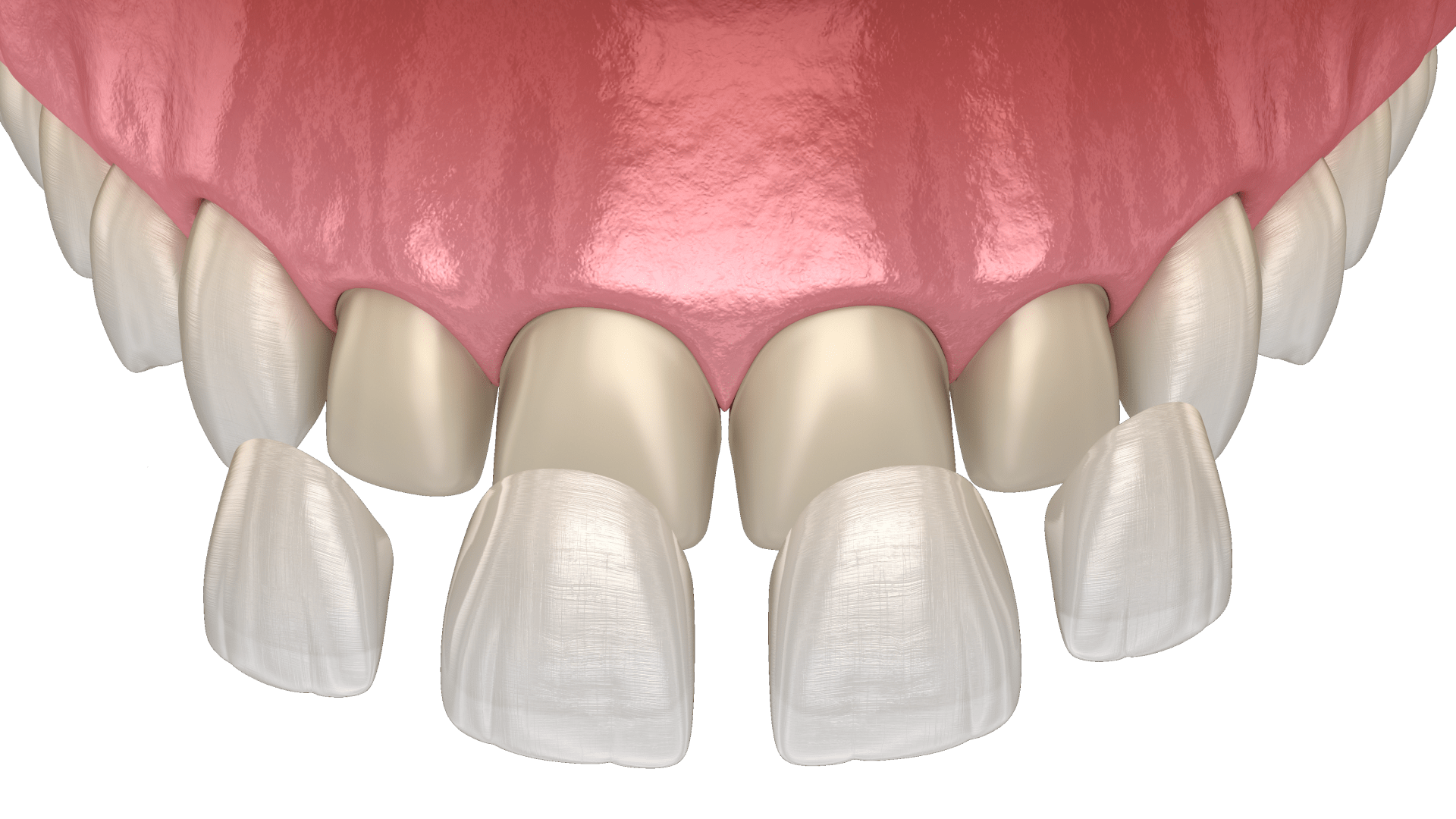 Встановлення вінірів