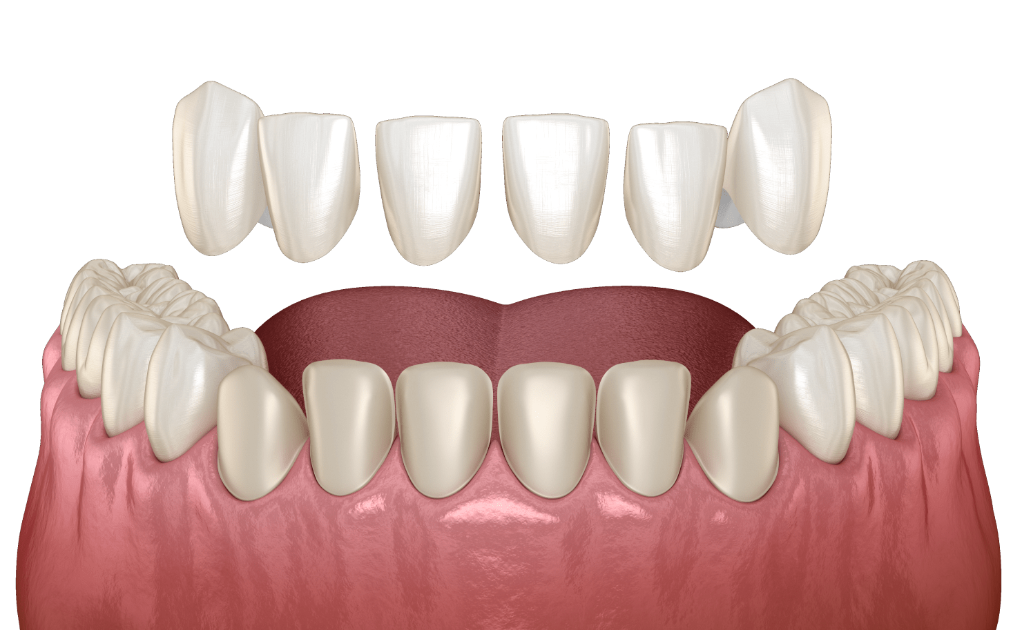 Встановлення вінірів