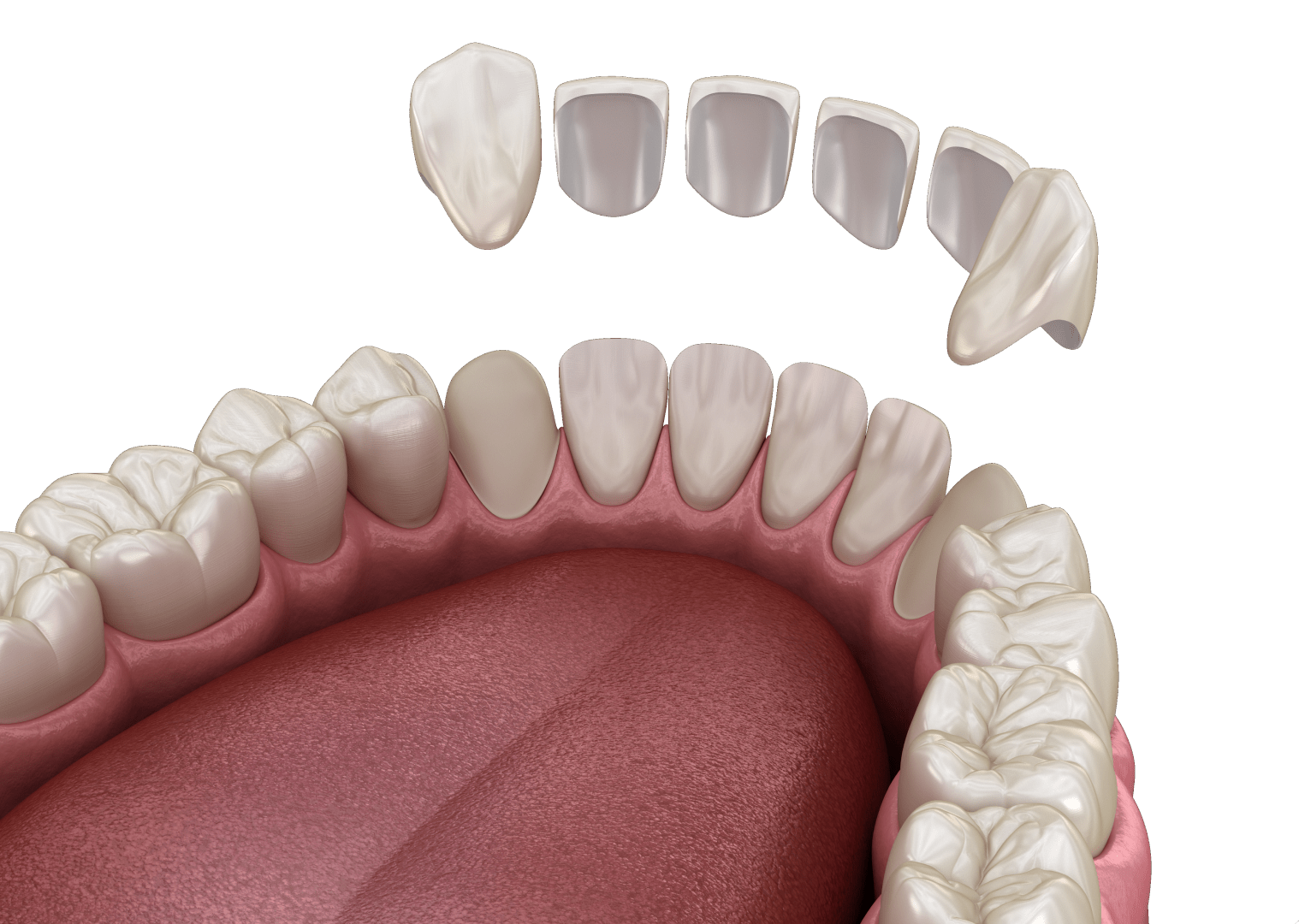 Підготовка зубів