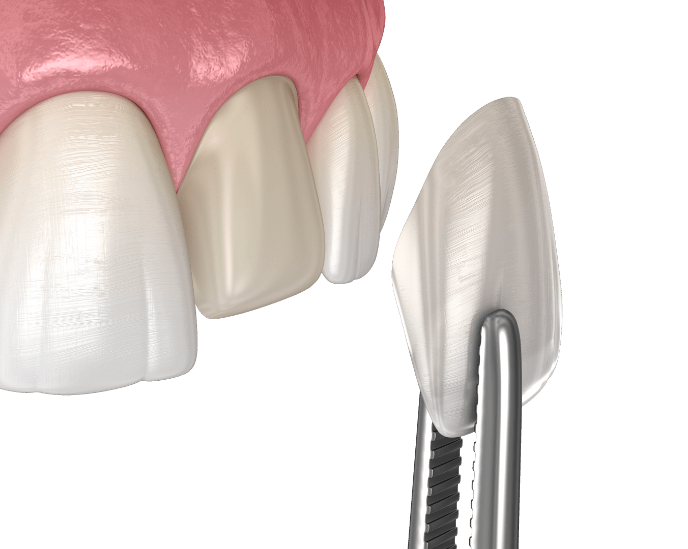 Встановлення зубів