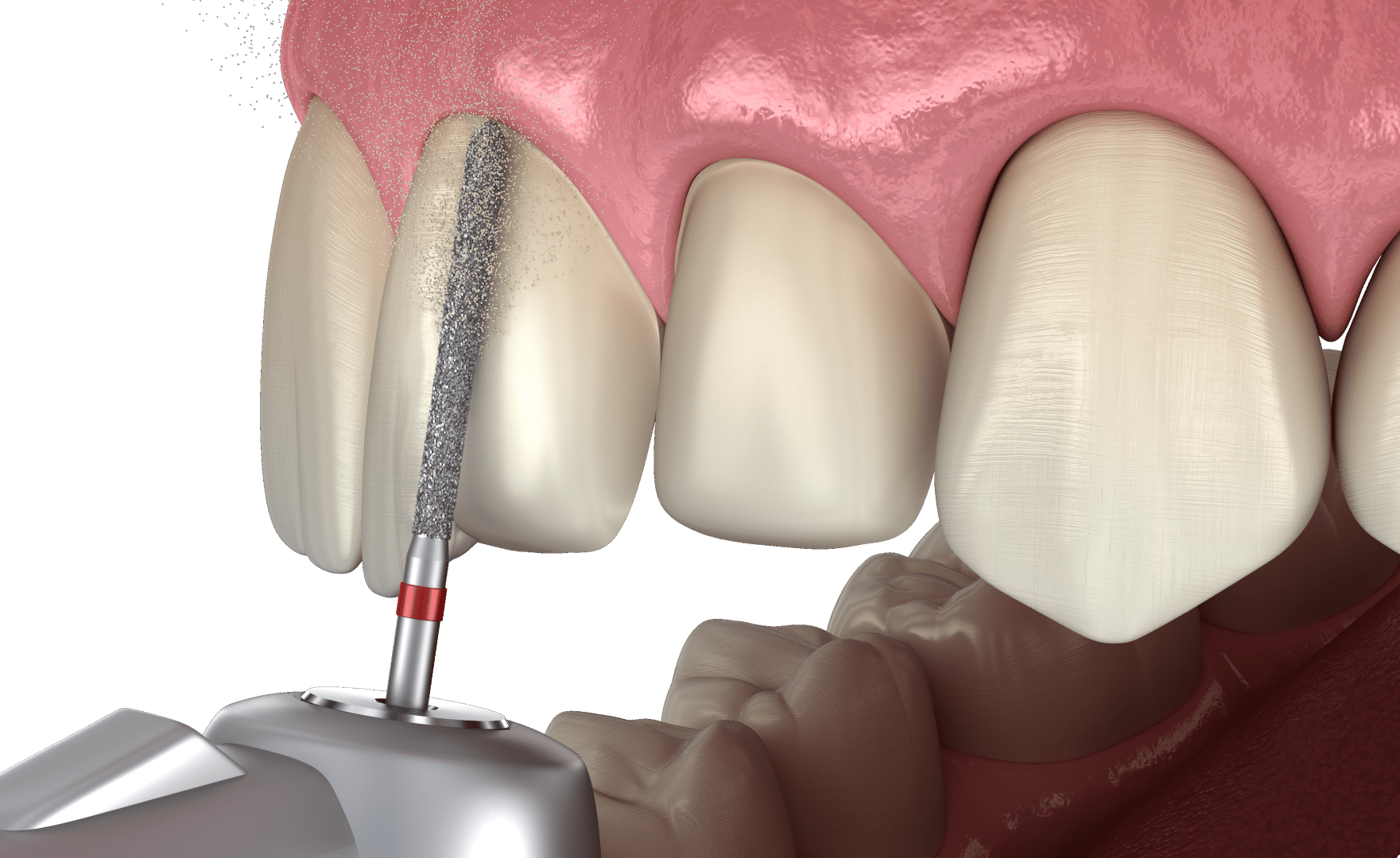 Підготовка до протезування